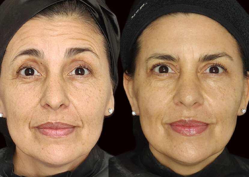 Aplicación de Toxina botulínica para arrugas faciales